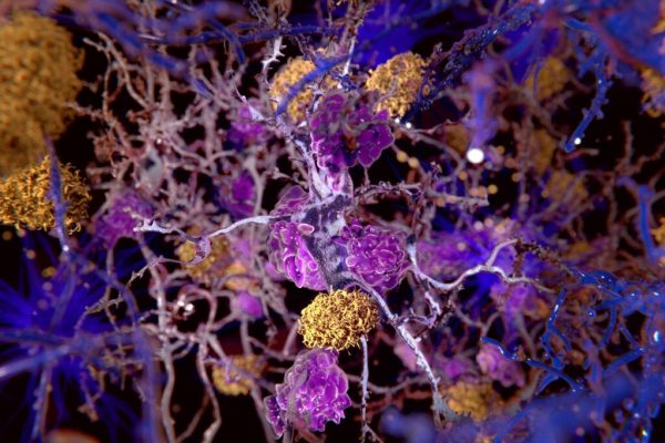 Inovație în tratamentul bolii Alzheimer: Medicamentul pe bază de cupru care curăță creierul de proteine toxice