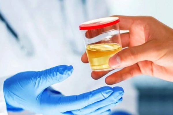 Culoarea urinei: Indicatori esențiali ai sănătății tale
