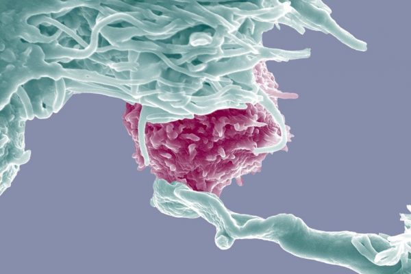 Diagnostic ratat: Povestea unei femei și lupta împotriva cancerului de col uterin în stadiu avansat