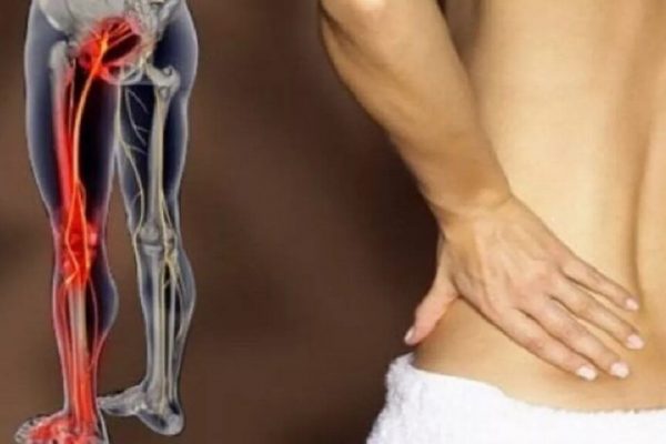 Să înțelegem mai bine sciatica: semnale de alarmă și opțiuni de tratament