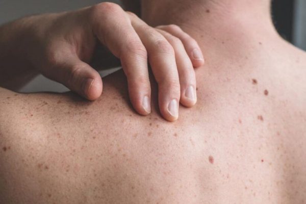Modificările alunițelor: Semnele care pot ascunde un cancer de piele și cum să ne protejăm