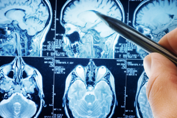 Riscuri Asumate: Contraceptivele cu Progestativ și Legătura lor cu Meningiomul
