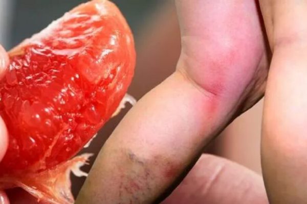 Înțelegerea trombozei venoase: simptome și riscuri majore asociate cu cheagurile de sânge