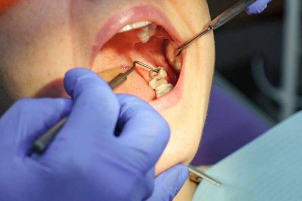 Extracția măselei de minte: Când este necesară și ce trebuie să știm