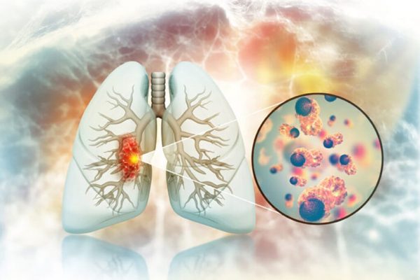 De ce unii fumători dezvoltă cancer pulmonar, iar alții nu? O analiză detaliată a unui studiu recent