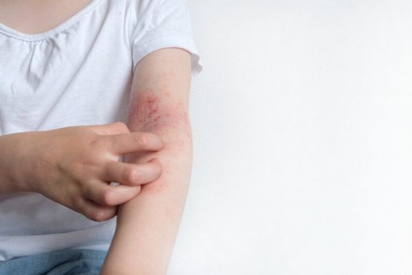 Dermatita Atopică: Semnele de Alarmă și Strategii de Control pentru o Viață Normală