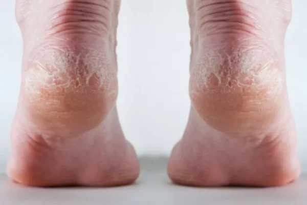 Picioarele uscate și diabetul: Un simptom inofensiv sau un semnal de alarmă?