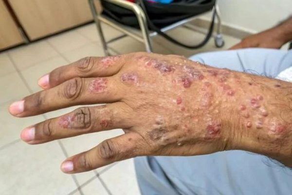 Renașterea leprei: O analiză a cazurilor în Florida și implicațiile pentru sănătatea publică