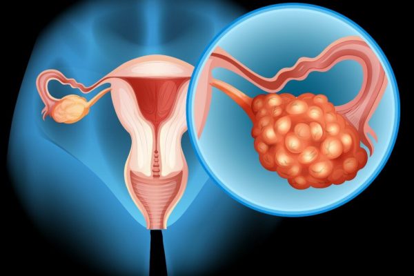 Semnele cancerului ovarian după menopauză: Importanța conștientizării simptomelor și evaluării medicale