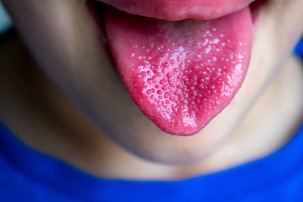 Limbajul Sănătății: Ce Ne Spune Aspectul Limbii Despre Deficiențele Nutriționale