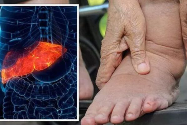 Ficatul Gras: Semnalul Ușor Ignorat de la Picioare și Importanța Diagnosticării Timpurii