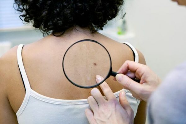 10 Semne Ascunse ale Cancerului de Piele: Ce Trebuie să Știm pentru a Ne Proteja