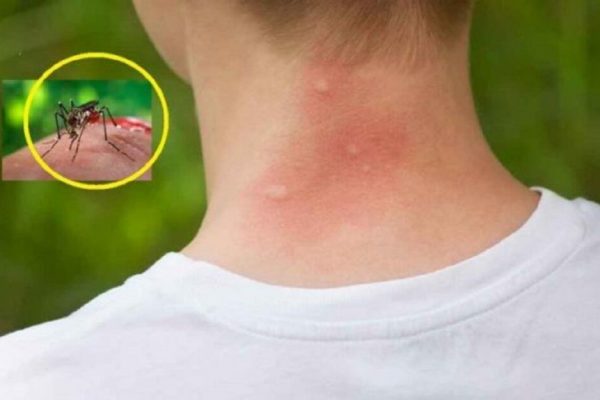 Cum bacteriile pielii influențează atracția țânțarilor: O nouă viziune asupra alegerii victimelor