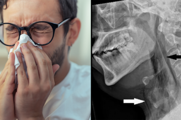 Riscurile strănutului oprit: Un gest banal care poate provoca leziuni grave