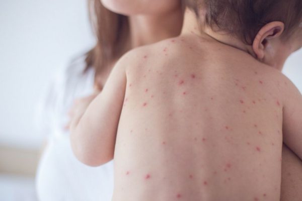 Atenție la Rujeolă: Importanța Vaccinării pentru Copiii în Vacanță în România