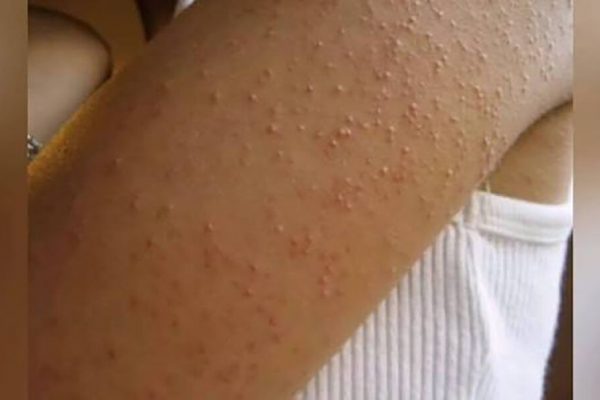 Semnele rezistenței la insulină: De la pielea de găină la problemele metabolice grave