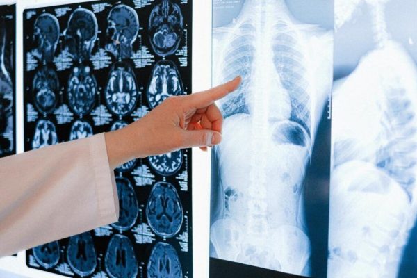 Impactul Opririi Studiului Clinic pentru Volrustomig: O Lovitură pentru Tratamentul Cancerului Pulmonar