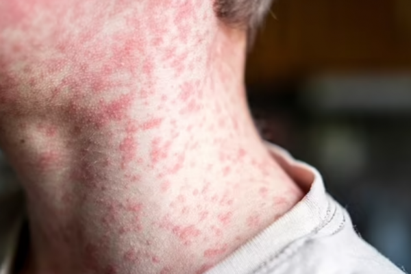 Rujeola revine în forță: Două decese în Pennsylvania și o epidemie alarmantă în SUA