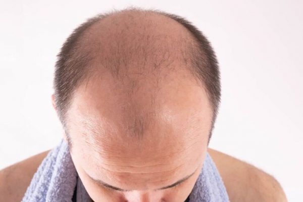 Regenerarea Părului: Progresele Revoluționare în Tratamentul Alopeciei Areata cu Upadacitinib
