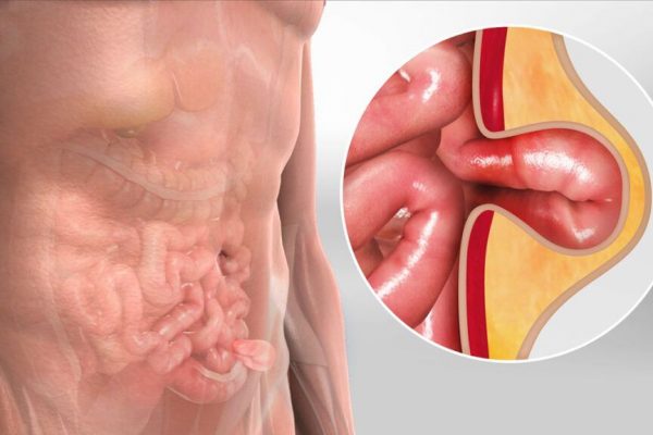 Hernia ombilicală: Ce trebuie să știi despre umflăturile din zona buricului