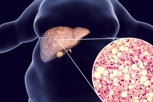 Uleiul de măsline extravirgin: Soluția recomandată de hepatologi pentru steatoza hepatică