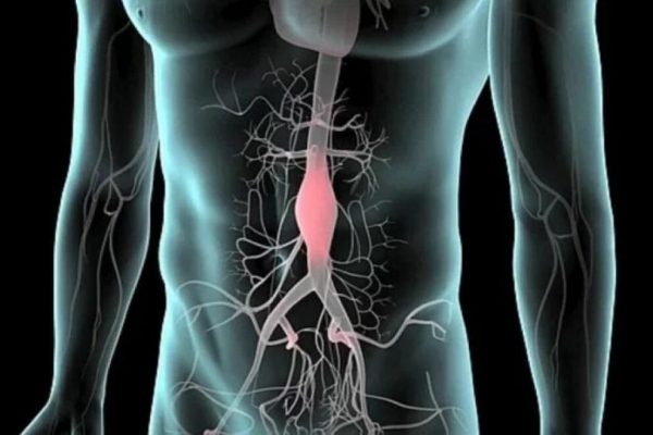 Senzația de puls în abdomen: semnalul care poate indica un anevrism de aortă abdominală