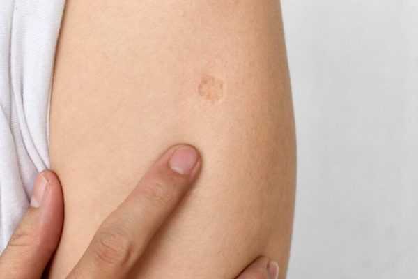 Cicatricea de pe braț: simbolul vaccinării și semn al solidarității globale în lupta împotriva tuberculozei