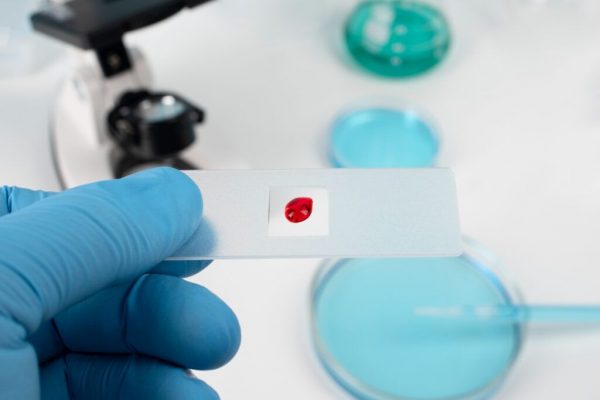 Progrese revoluționare în diagnosticarea Alzheimer: Un test simplu din sângele capilar poate schimba viitorul sănătății mentale