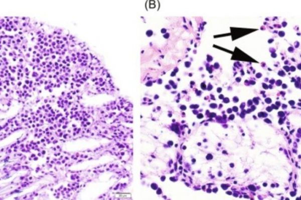 Cancerul pediatric: O privire detaliată asupra disparităților în șansele de supraviețuire la nivel global
