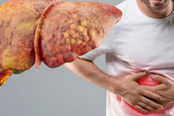 Legătura Complexă dintre Ficatul Gras și Refluxul Gastroesofagian: O Analiză Detaliată a Studiului Pe Peste 800.000 de Oameni