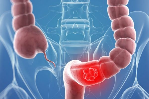Impactul cărnii procesate asupra sănătății: Ce trebuie să știm despre riscurile cancerului colorectal