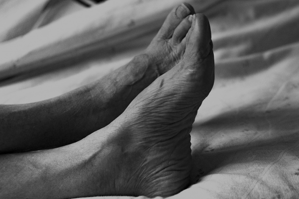 Tragedia unui pensionar de 80 de ani: diagnosticul târziu al bolii arteriale periferice și impactul asupra vieții sale