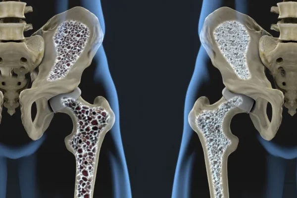 Revoluția în Tratamentul Osteoporozei: O Perfuzie cu Celule Stem Reduce Fracturile cu 94% la Femeile Aflate în Risc